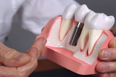 ایمپلنت دو دندان کنار هم یا بیشتر چگونه انجام می شود؟