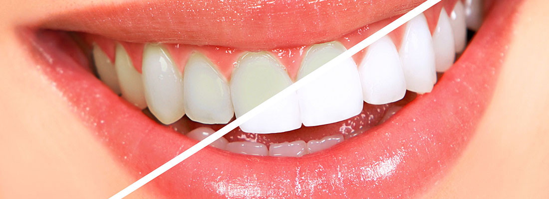 سفید کردن دندان در مطب