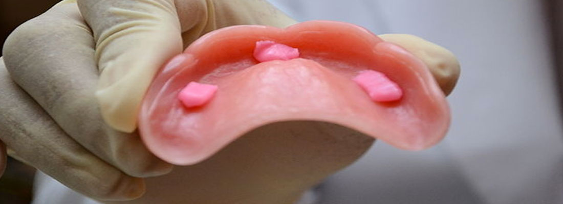 روش کاشت دندان با چسب