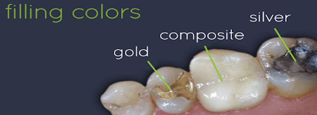 انواع مواد مختلف برای پر کردن دندان