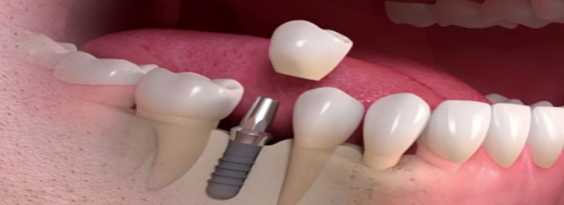 انواع کاشت دندان ثابت