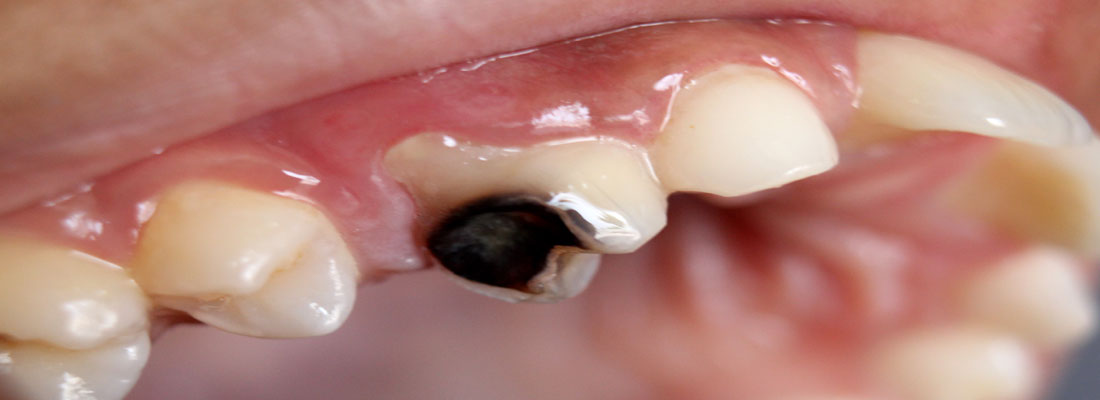 فرآیند ترمیم سه سطحی دندان