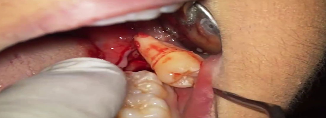 چگونگی عمل جراحی دندان عقل