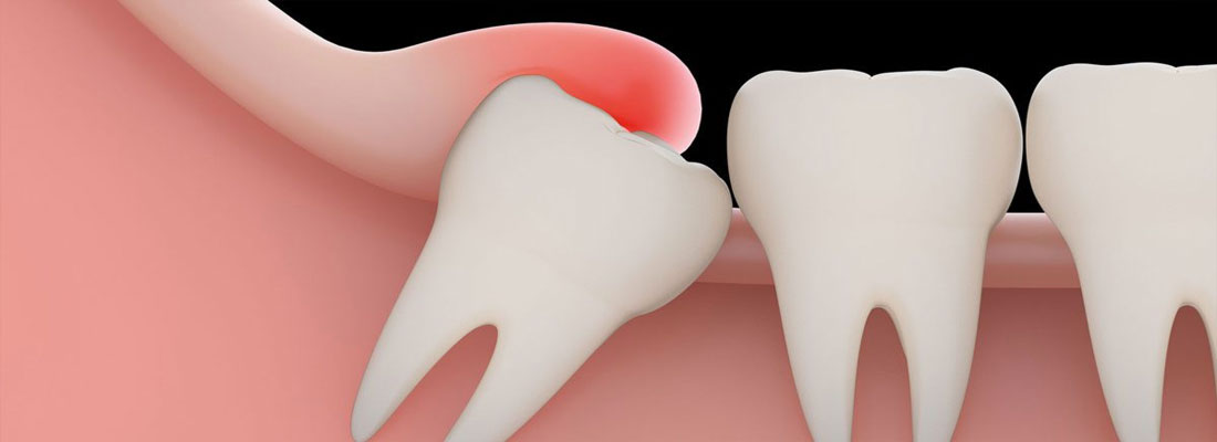 میزان نهفتگی دندان عقل