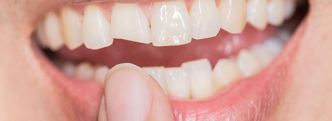 آسیب های احتمالی بلیچینگ دندان در سن کم