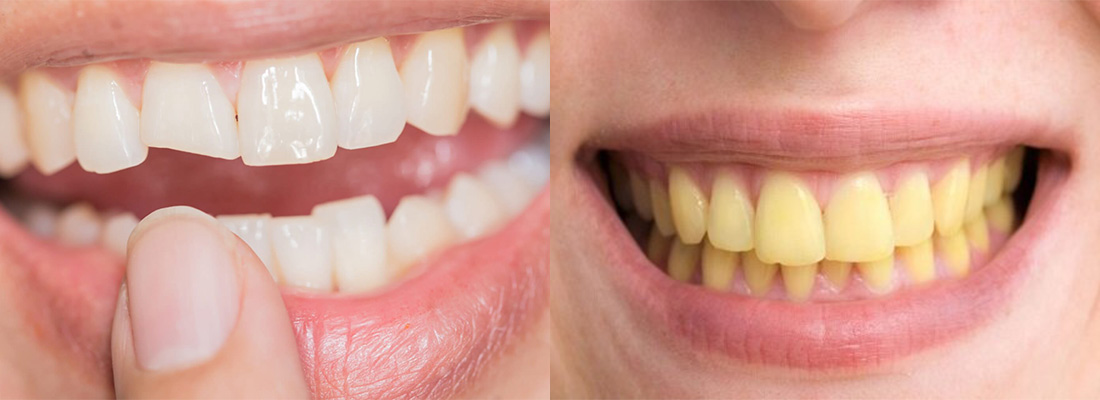 از کامپوزیت دندان در چه مواردی استفاده می شود 