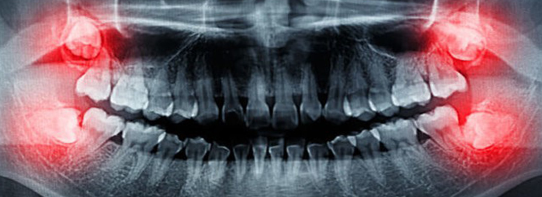 اسیب هایی که دندان عقل نهفته وارد می کند چیست