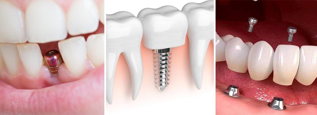 انتخاب بهترین نوع ایمپلنت دندان