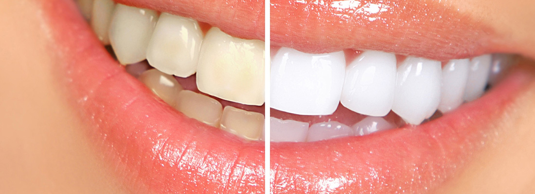 انواع روش های زیبایی دندان