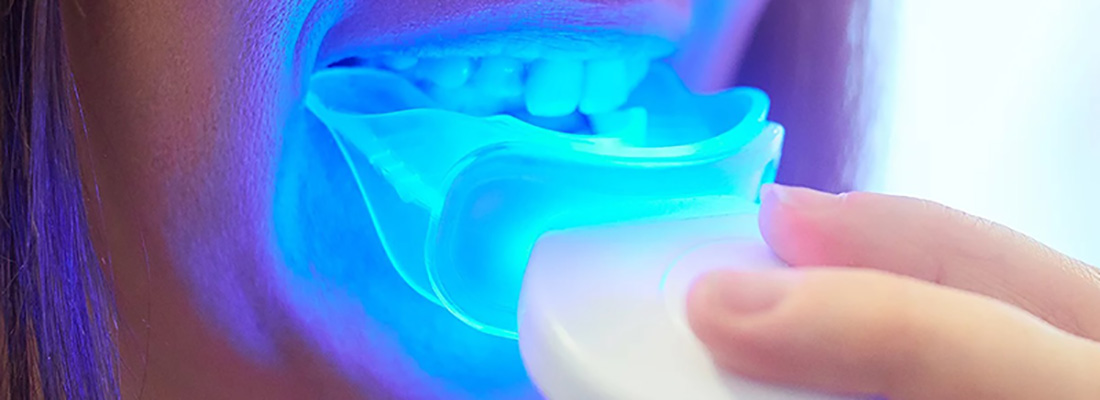 انواع روش های سفید کردن دندان