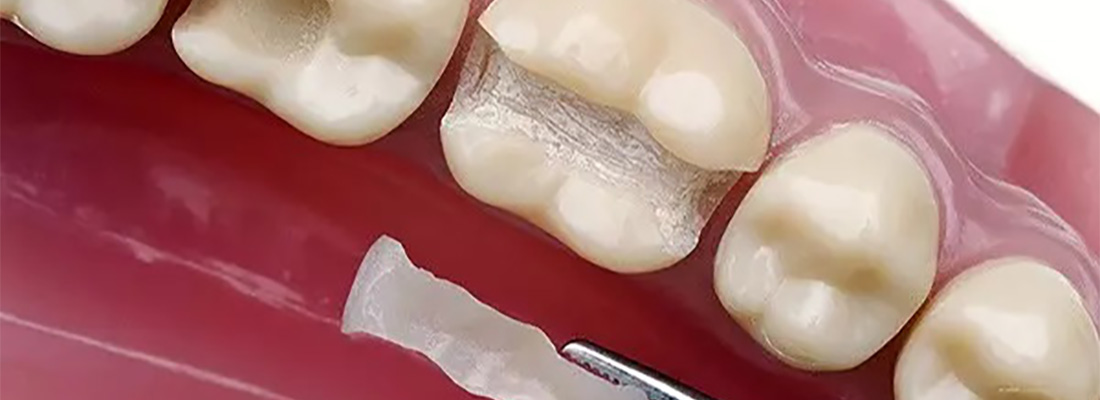 انواع مواد ترمیم دندان