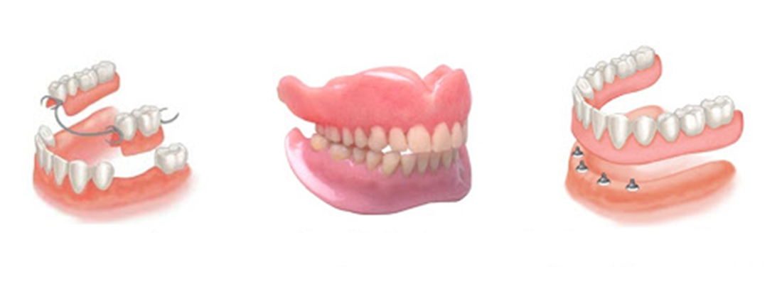 انواع دندان مصنوعی متناسب با نیاز شما