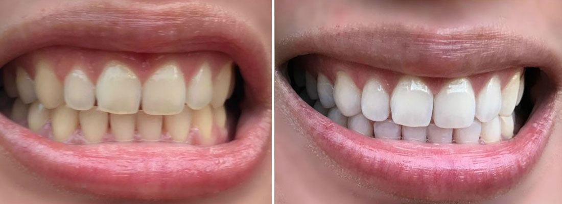 بریج و بریجینگ دندان چیست