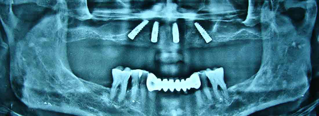 تصویر رادیولوژی از فک دندان
