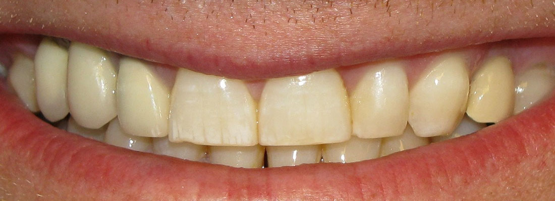 عوامل تاثیر گذار بر رنگ دندان