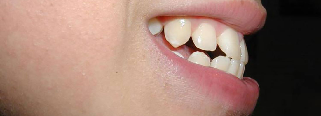 تعریف مال اکلوژن دندان