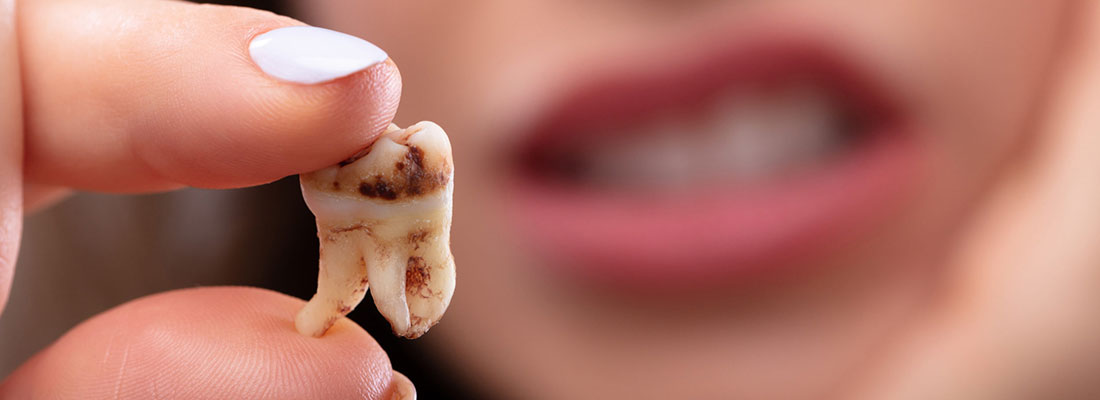 جلوگیری از پوسیدگی دندان2