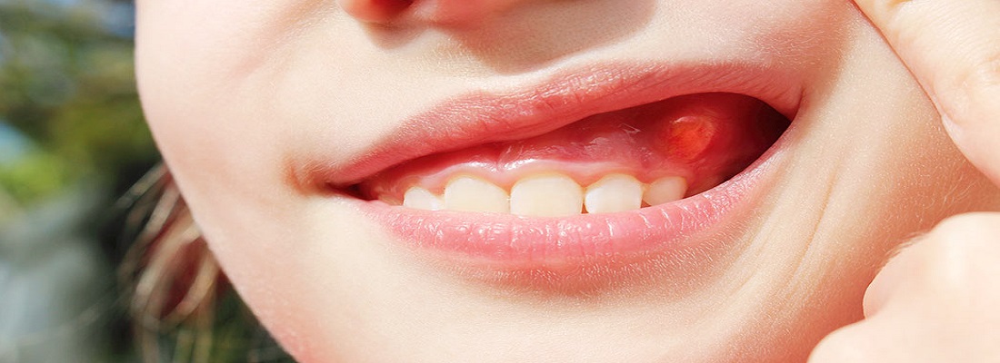 درمان آبسه دندان