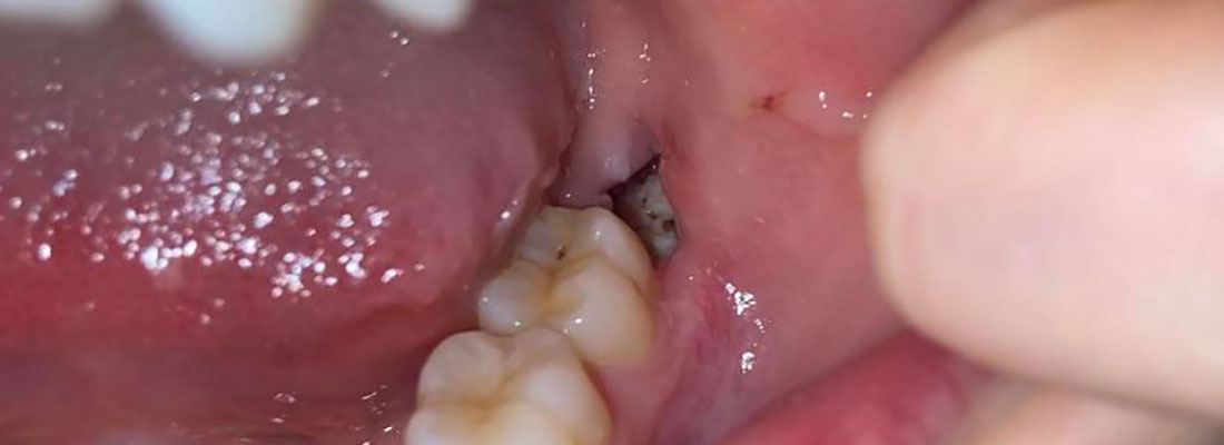 درمان درد و عفونت دندان