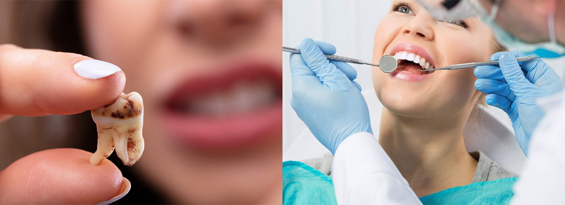 درمان پوسیدگی دندان ها