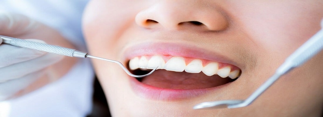 درمان جرم گیری دندان