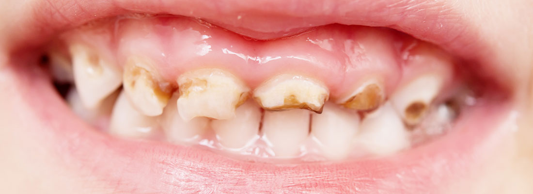 درمان های ساده در خصوص کرم خوردگی دندان