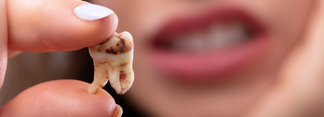 کرم خوردگی دندان چیست