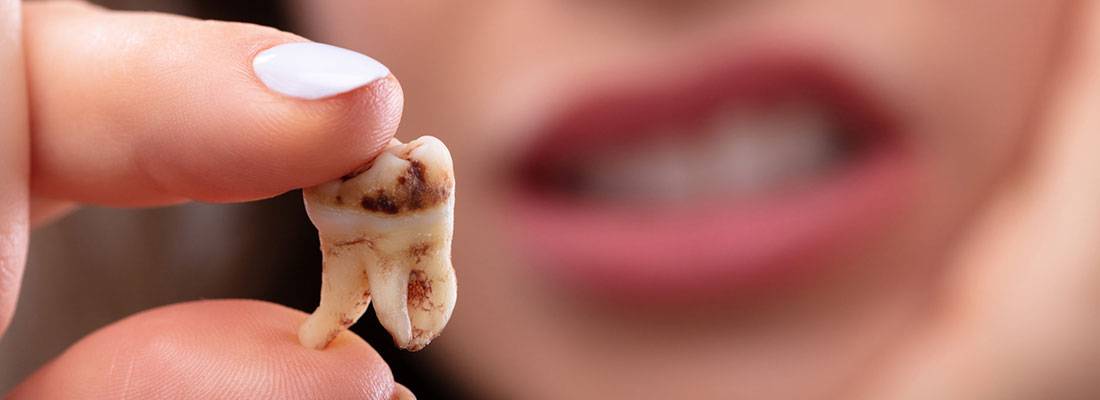 عفونت دندان به دلیل پوسیدگی