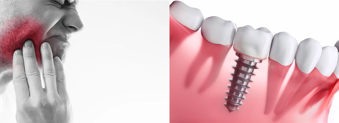 راه های ایمپلنت دندان بدون عوارض