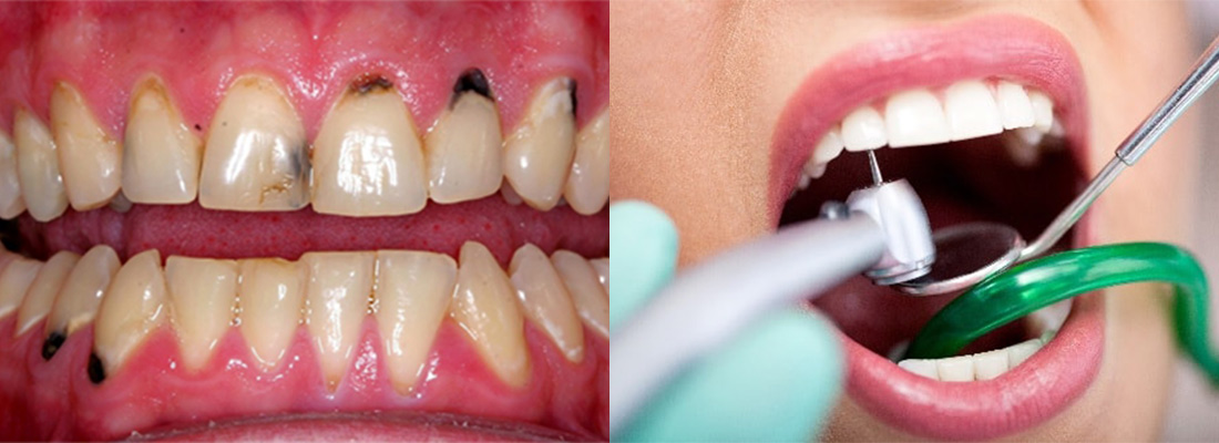 راه های درمان پوسیدگی بین دو دندان