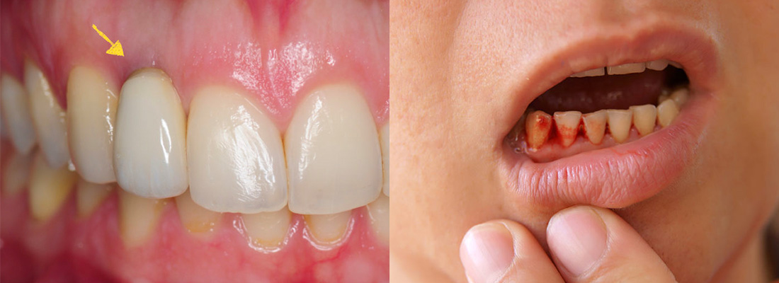 علائم عفونت در ایمپلنت دندان