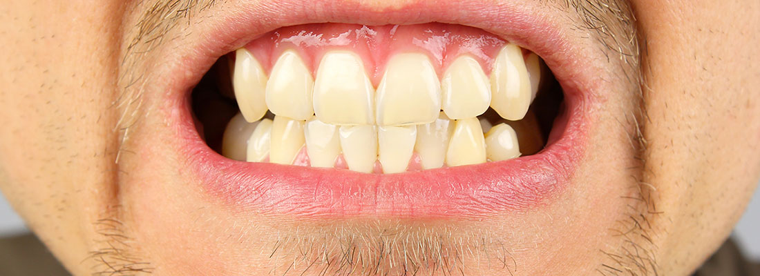 علائم و نشانه های دندان قروچه