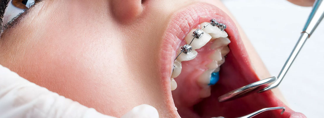 علت درد ارتودنسی دندان چیست