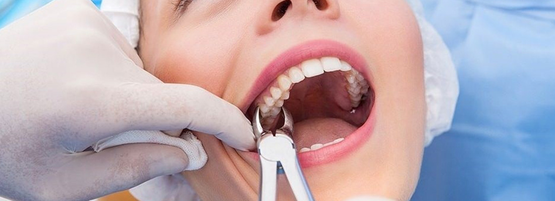 علت مهم بودن کشیدن دندان عقل در چیست
