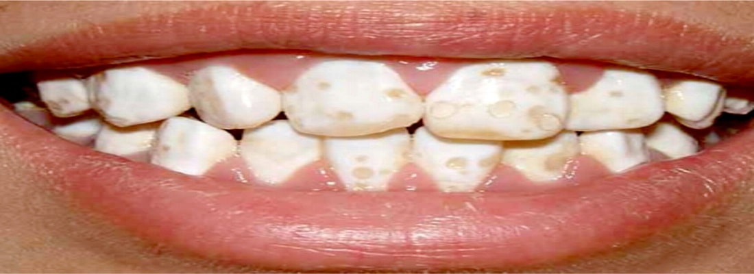 عوارض جرم گیری دندان