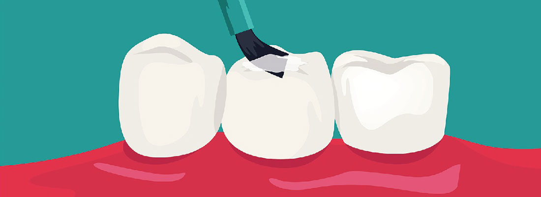 فیشور سیلانت دندان چیست2