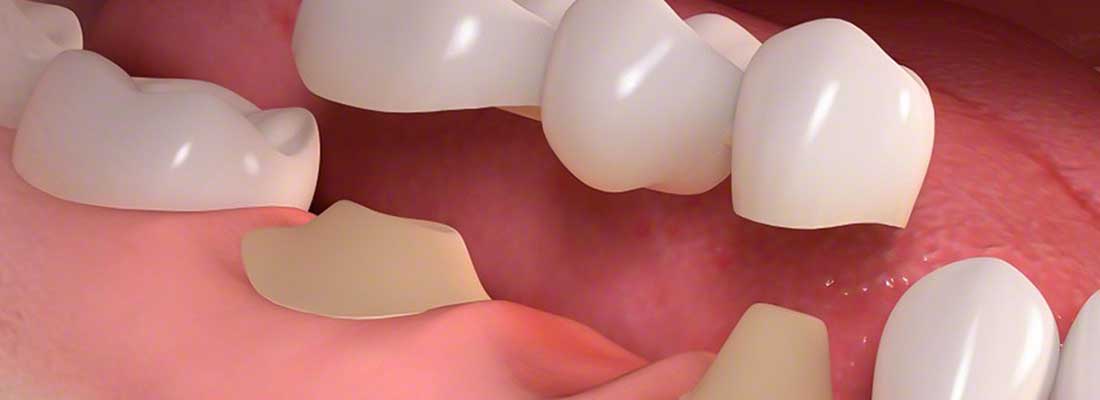 لغزش بریج دندان هنگام لمس کردن