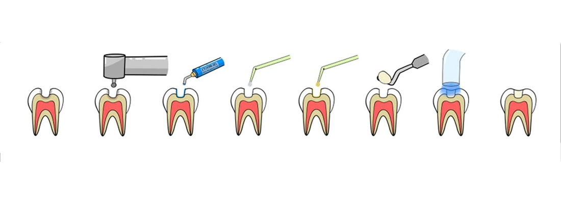 مراحل قرار دادن کامپوزیت ونیر روی دندان 