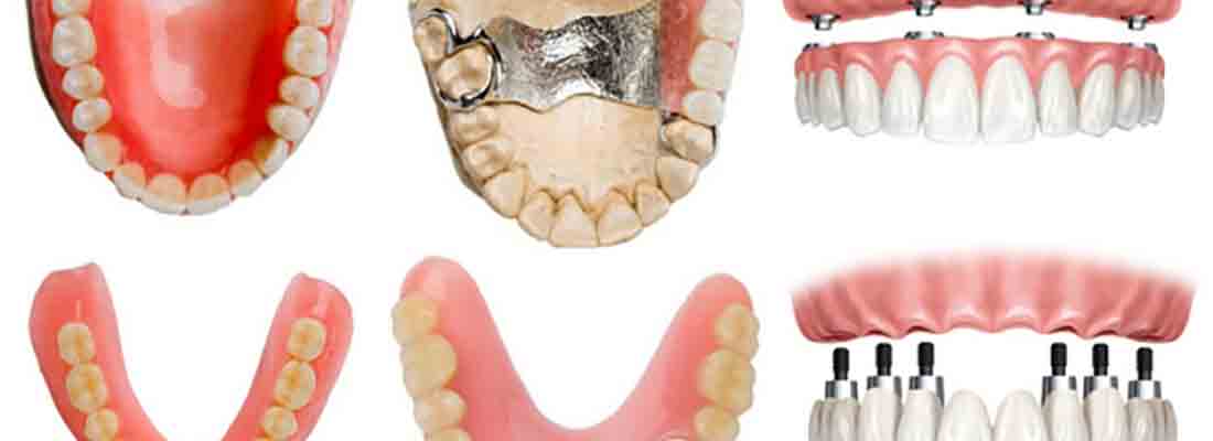 مراحل انجام پروتز دندان