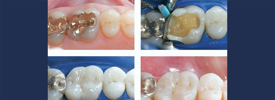 مراحل کف بندی دندان