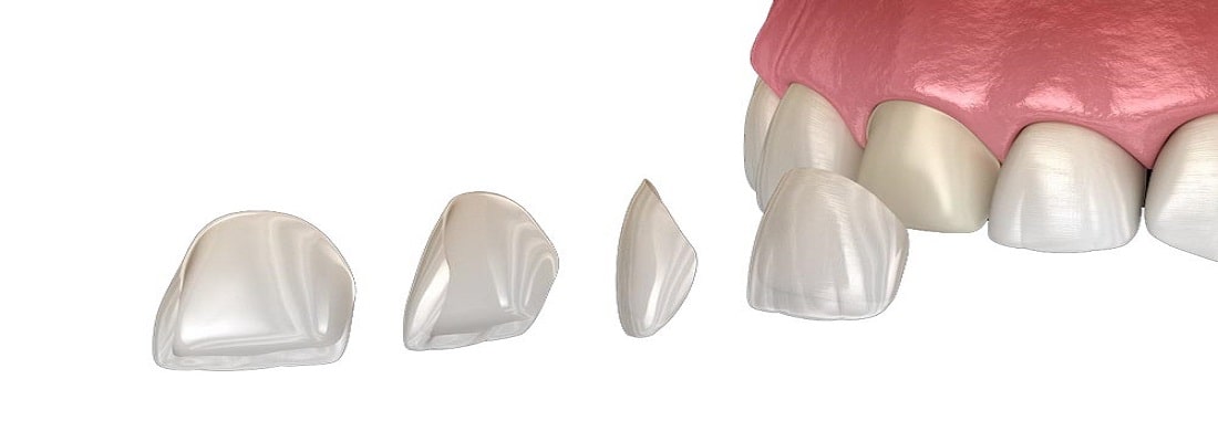 مراحل نصب لمینت دندان بدون تراش