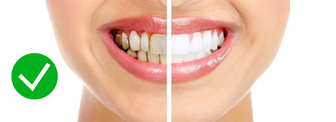 مزایای رفع پوسیدگی بین دو دندان چیست 