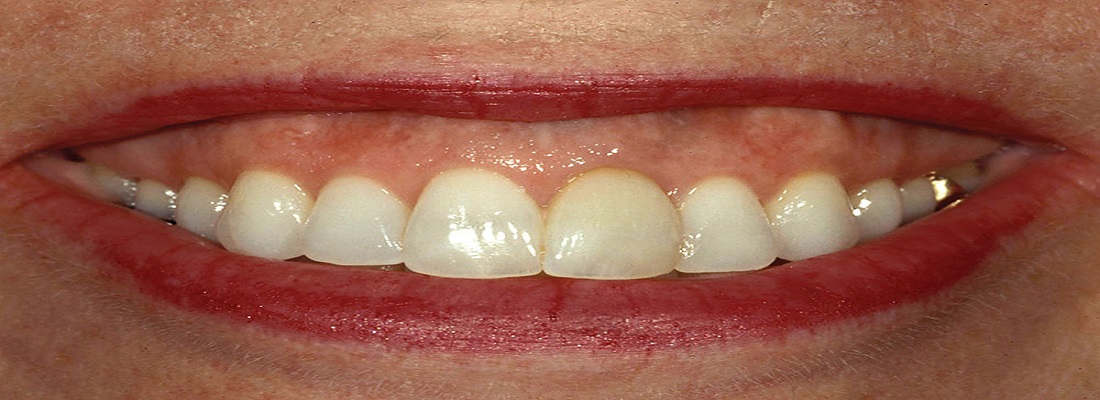مشکلات عصب کشی دندان