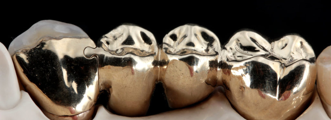 تاج دندان طلا