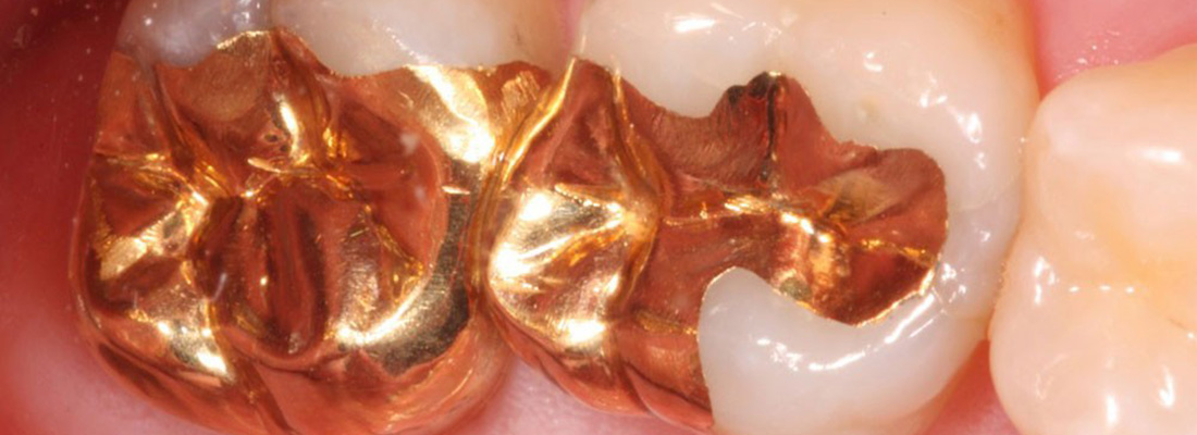 پر کردن دندان با آمالگام طلا
