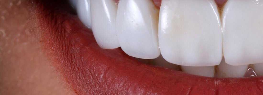 کامپوزیت دندان سفید درخشان