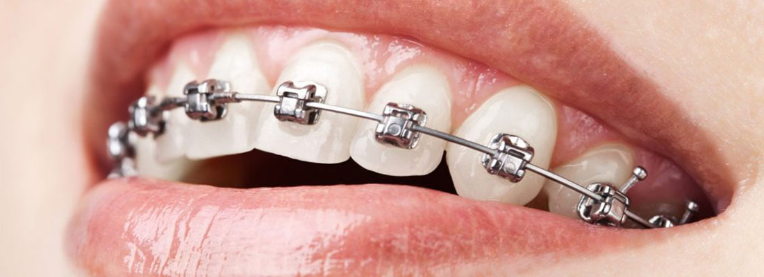 چگونه درد ارتودنسی دندان را کم کنیم2