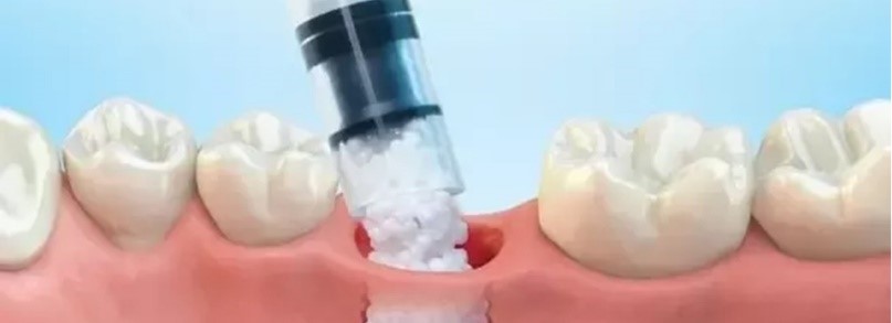 کاشت دندان طبیعی سلول بنیادی