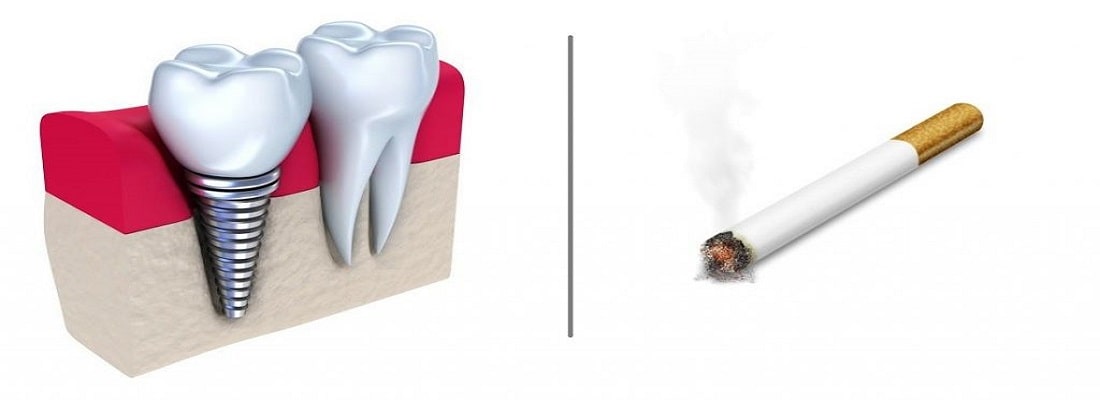 کاشت پانچ دندان چه مزایایی دارد