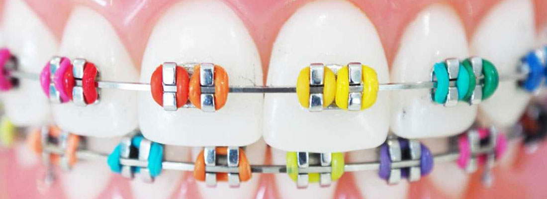 براکت ارتودنسی دندان